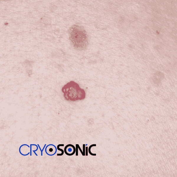 Looking for pain free cherry angioma removal treatment Chichester? Call our team today! Chichester