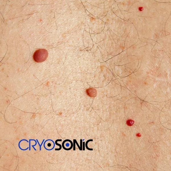 get cherry angioma removal treatment today! Chichester