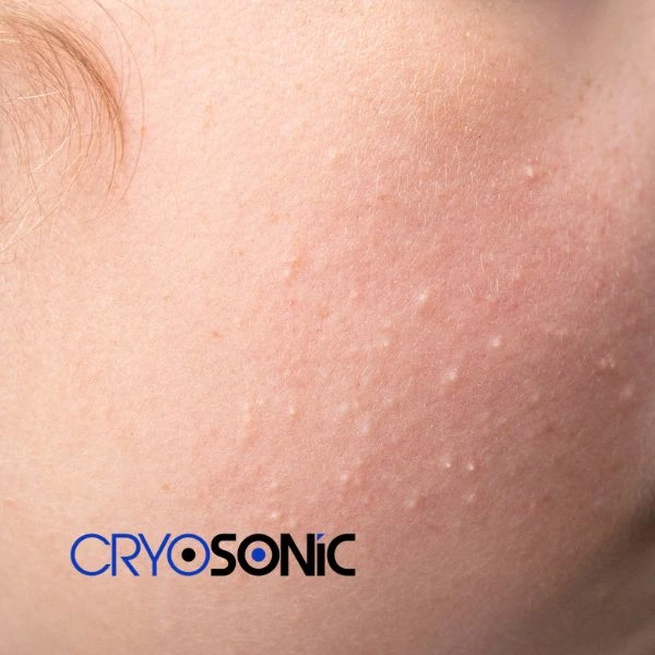 Are you looking for milia removal treatment? Contact our team today Chichester