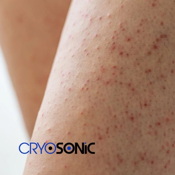 Looking for Seborrhoeic Keratosis removal Chichester treatment? Call our consultants today in Chichester