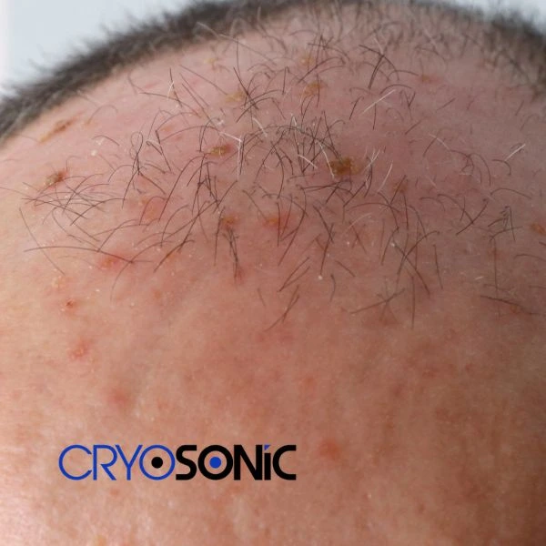 Access Seborrhoeic Keratosis removal from the comfort of your own home! Call us today in Chichester