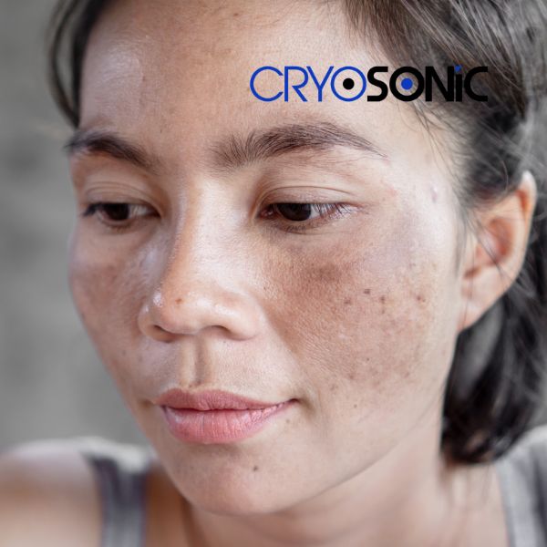 Ready to start age spots removal? Contact our team today in Chichester