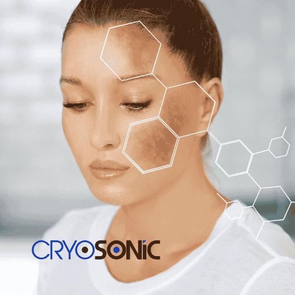 Are you looking for age spot removal treatment? Contact Cryosonic today in Chichester