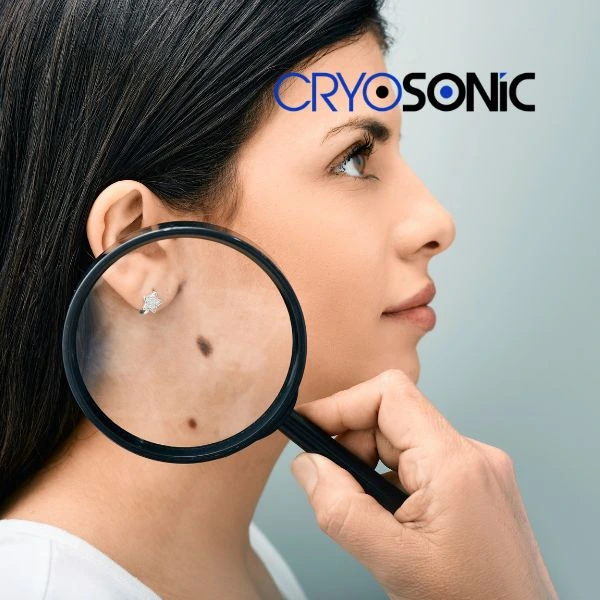 Do you want to learn more about benign moles removal treatment? Call our team today Chichester