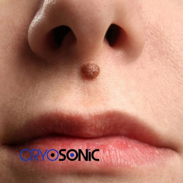 Start your benign moles removal treatment today Chichester
