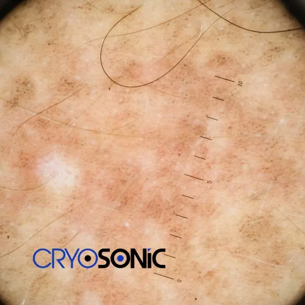 Speak to our team today about sun damaged skin treatment today in Chichester