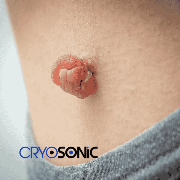 Book your skin tags removal Chichester from comfort of your own home! Chichester