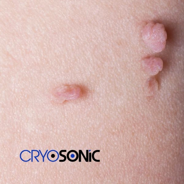 Are you looking for fast effect skin tag removal Chichester? Book in NOW! Chichester