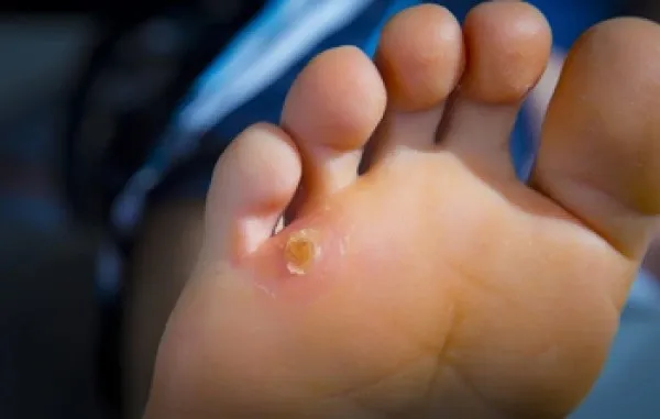 What Are the Most Common Mistakes People Make That Lead to Verruca Infections Chichester