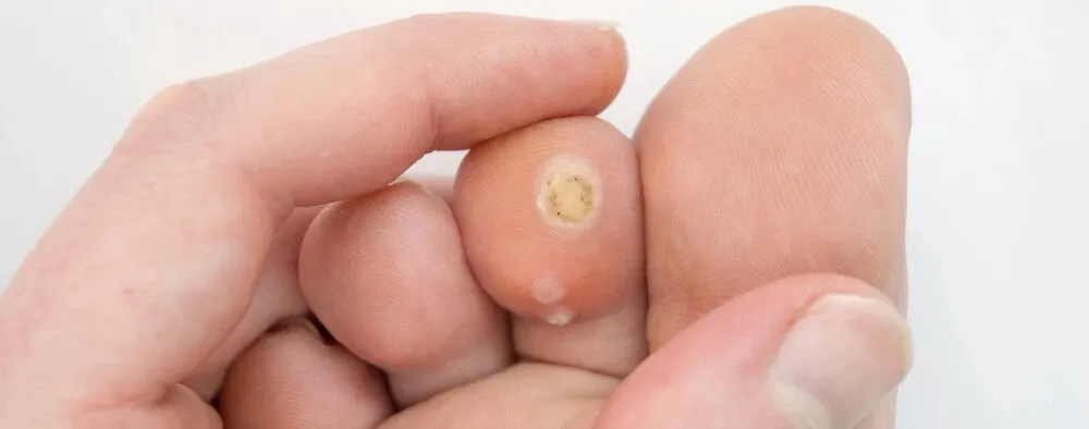 Verruca is Painful and causing discomfort on the bottom of the foot Chichester