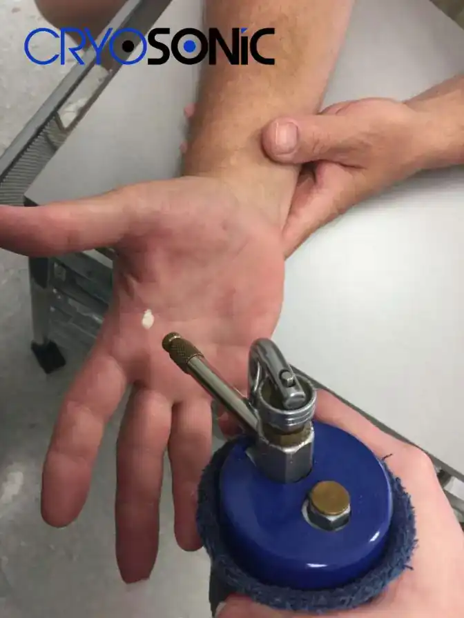 Temperature Differences: OTC vs Medical-Grade Cryotherapy Chichester